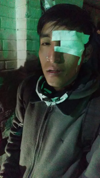 Mijael Lian Lamas de 17 años perdió el ojo por la represión de Morales