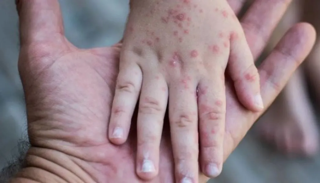 83662-con-la-aplicacion-de-la-vacuna-se-previene-el-sarampion