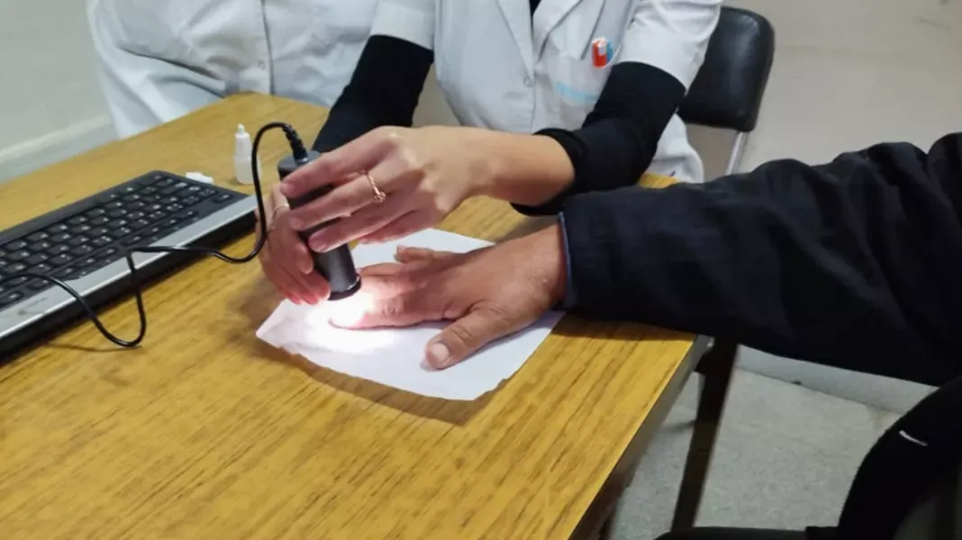 esclerodermia