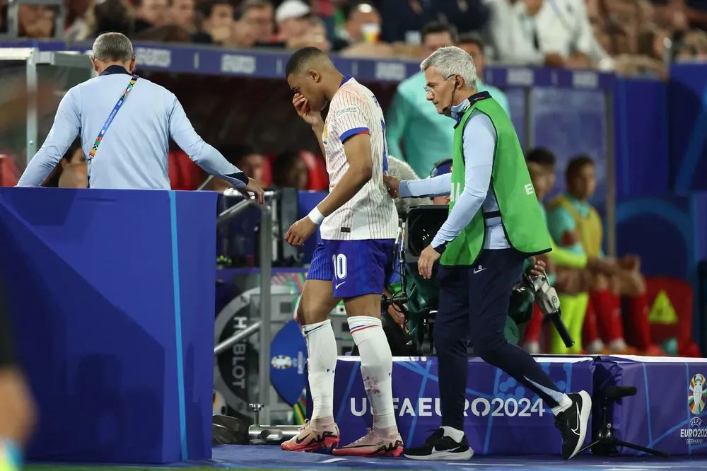 Kylian Mbappé se rompió la naríz (4)