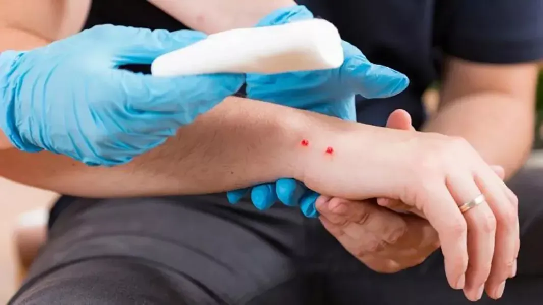 mordeduras de víbora