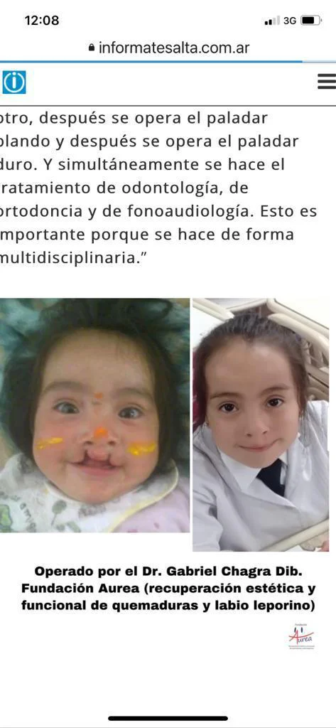 labio leporino (2)