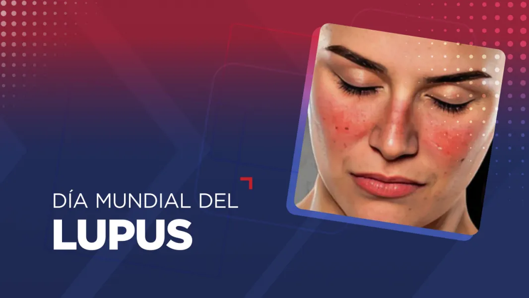 95552-el-lupus-es-una-enfermedad-de-dificil-diagnostico-y-aun-no-tiene-cura