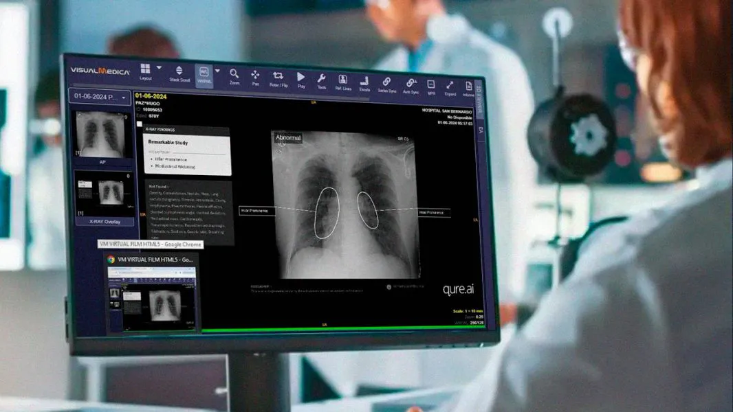 97362-el-hospital-san-bernardo-es-pionero-en-la-implementacion-de-inteligencia-artificial-para-la-deteccion-temprana-de-cancer-de-pulmon